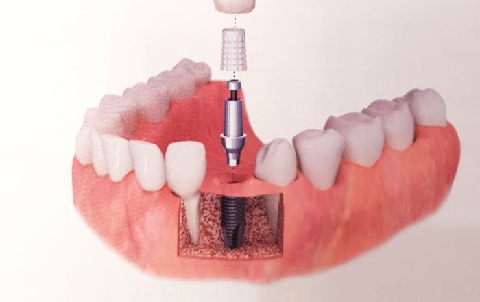 infografía de como se ubica un implante dental
