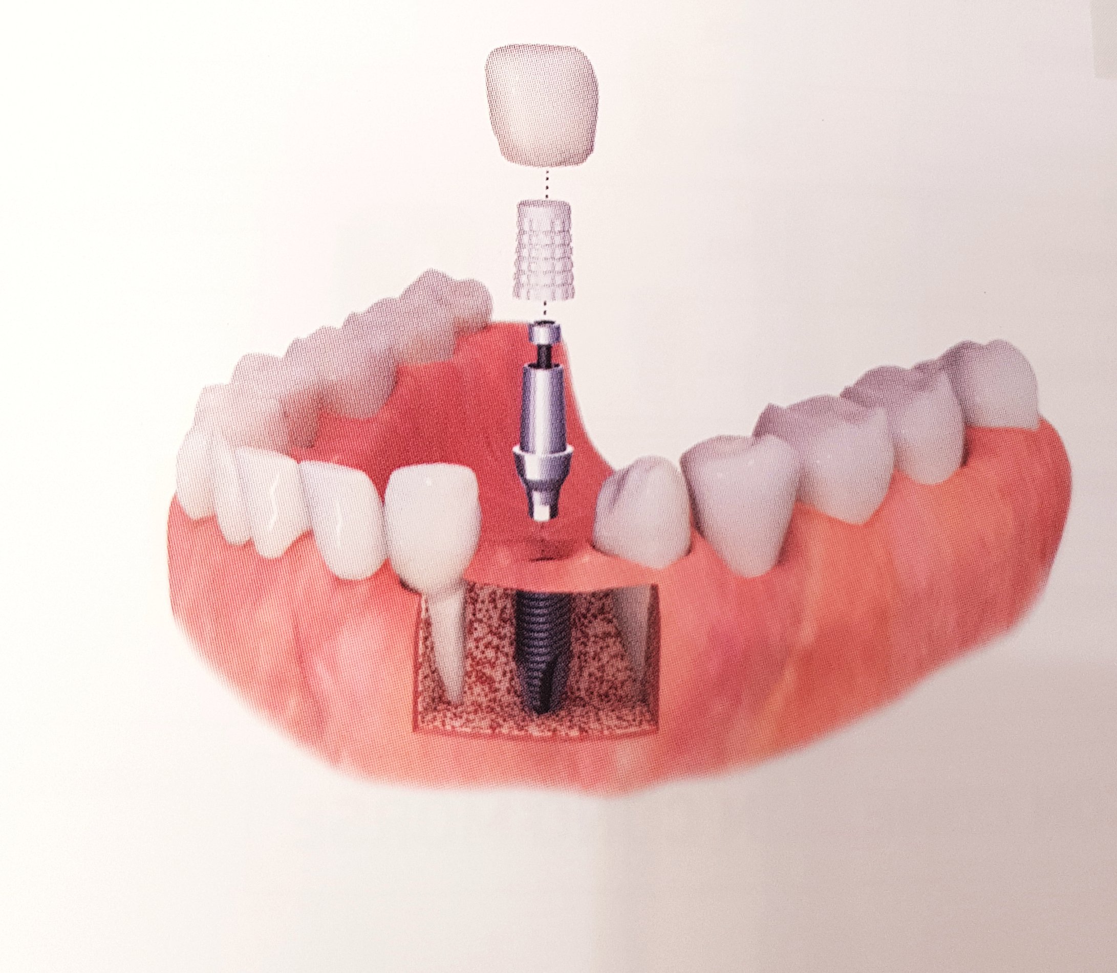 infografía de como se ubica un implante dental