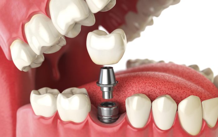 implante dental en la zona de las muelas