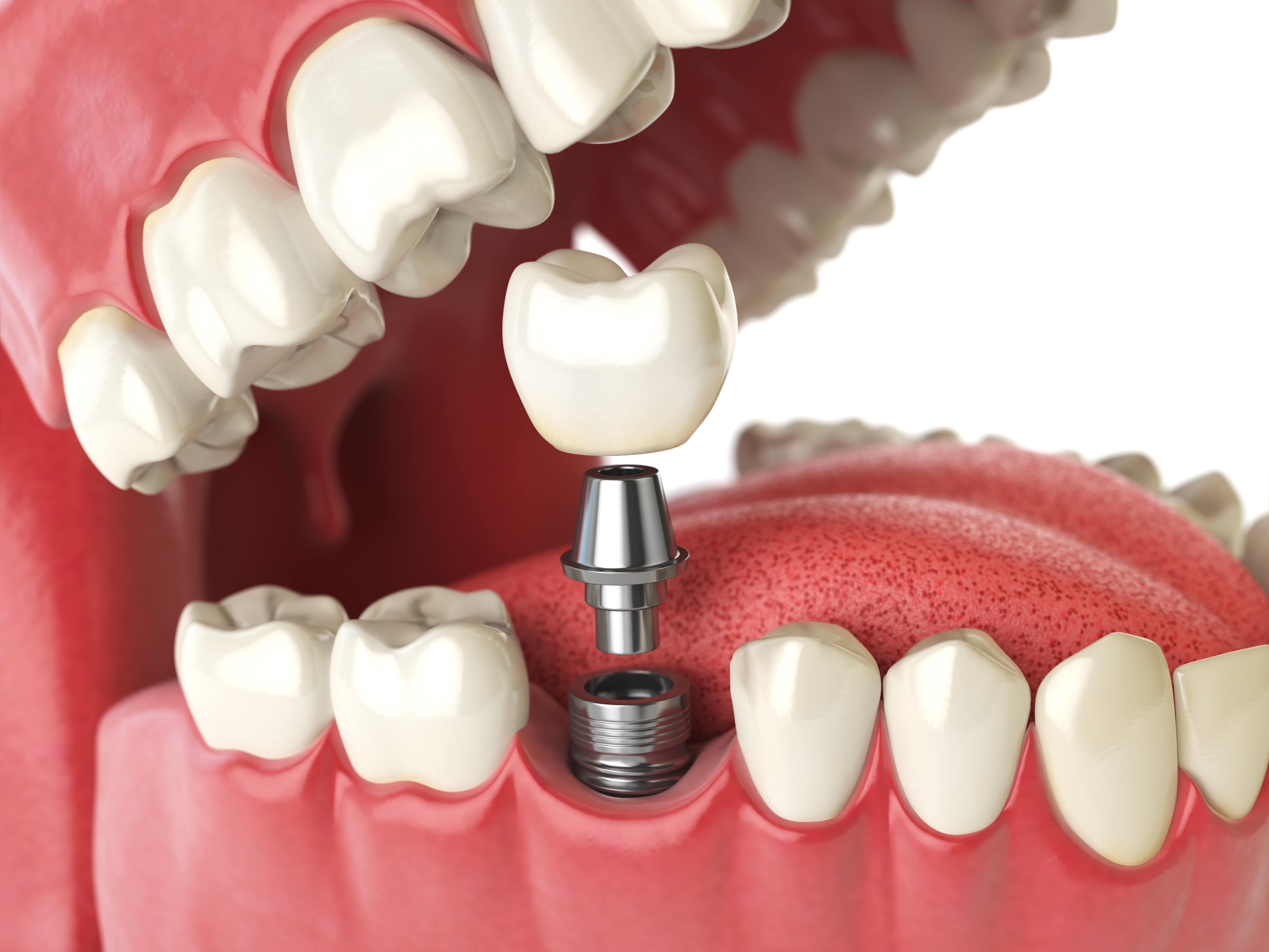 implante dental en la zona de las muelas