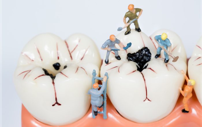 trbajadores dentro de una muela con caries