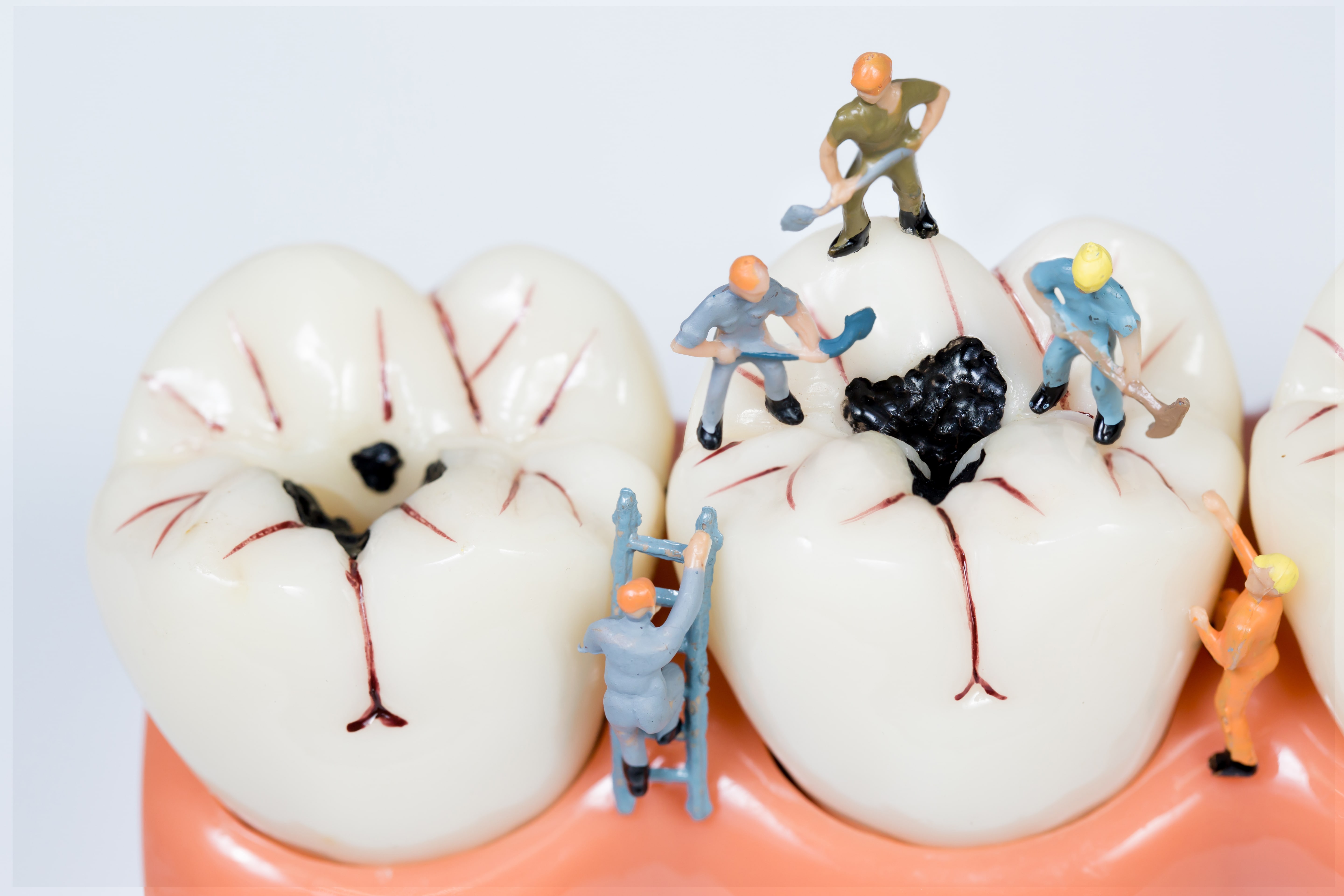 trbajadores dentro de una muela con caries