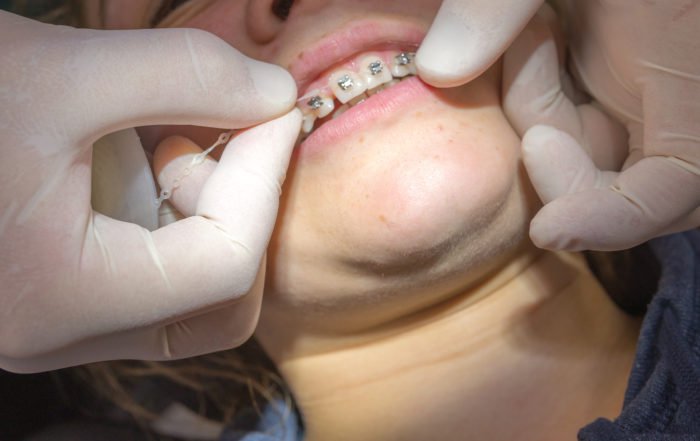 Dentista poniendo unos brackets
