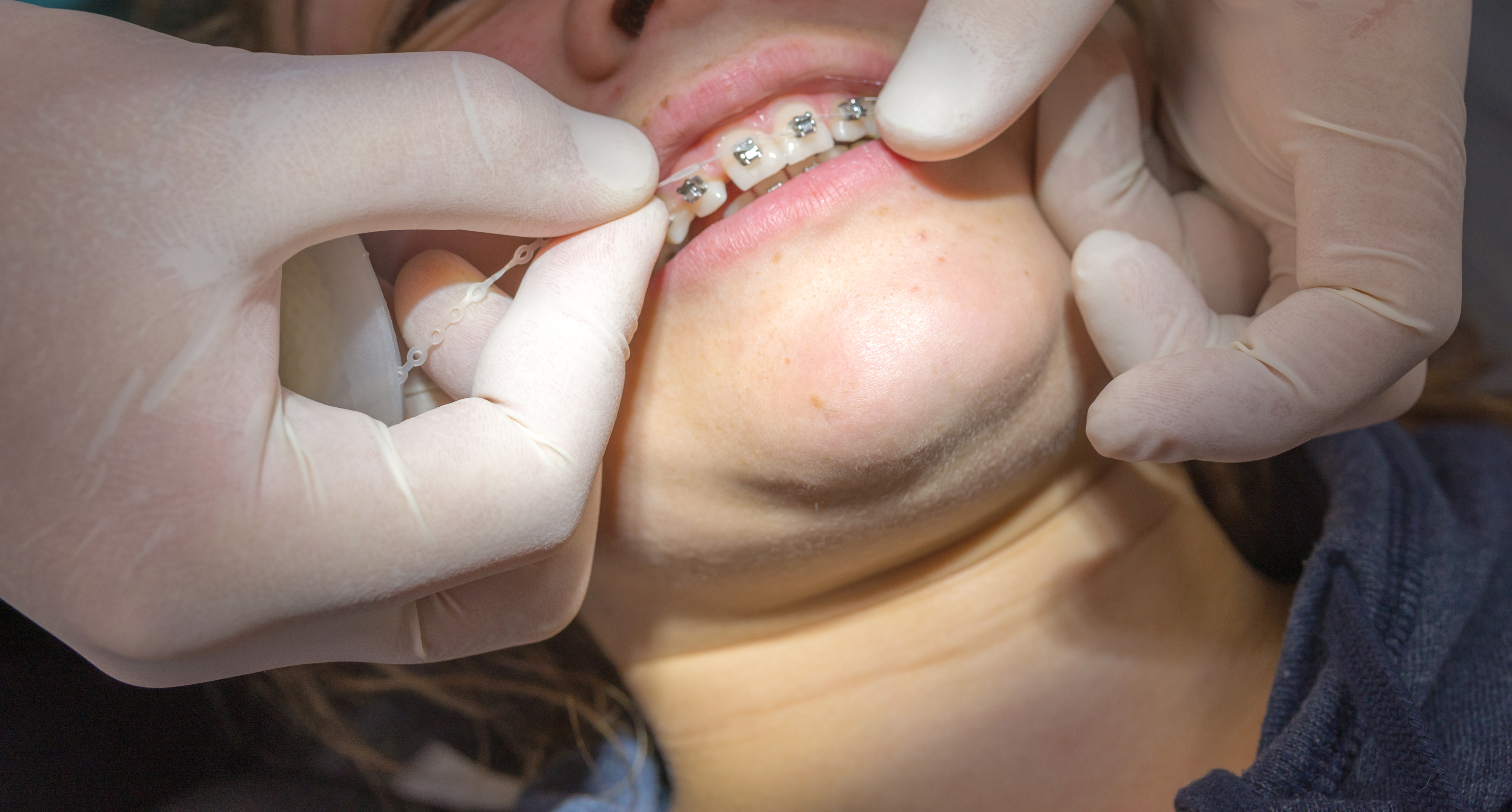 Dentista poniendo unos brackets