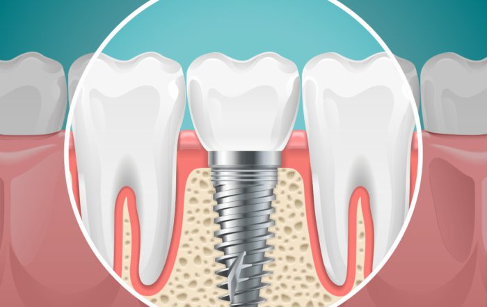 Tornillo de un implante dental