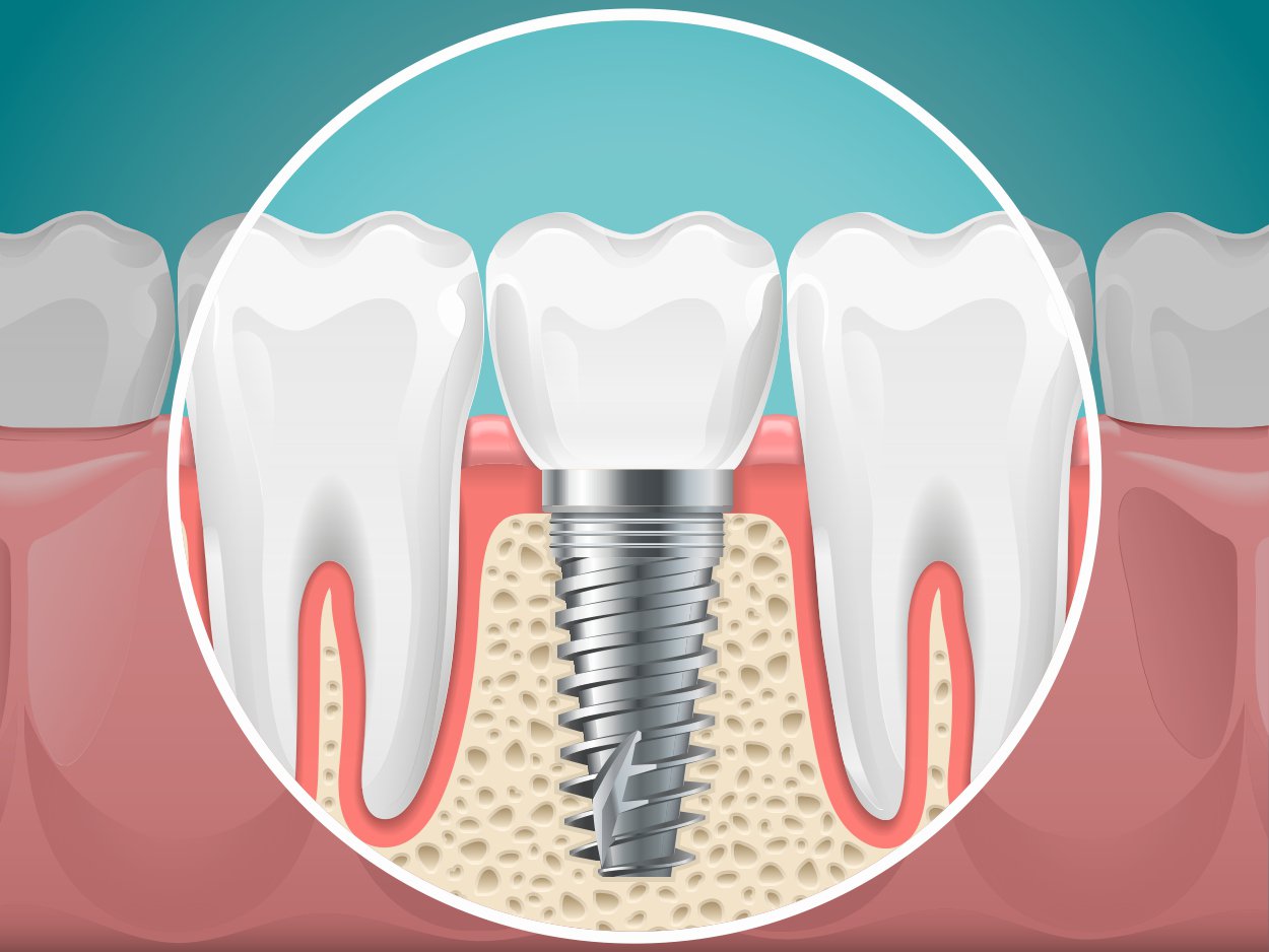 Tornillo de un implante dental