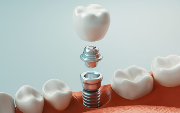 Como se pone un implante dental en la boca