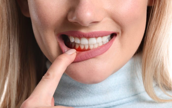 Como se ve la gingivitis