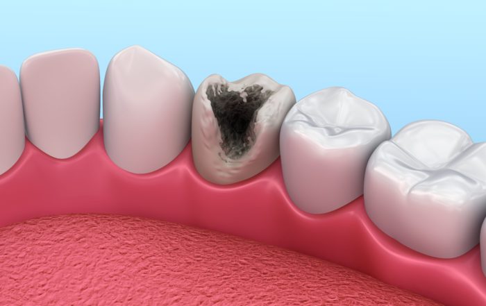 cómo afecta la caries a un diente