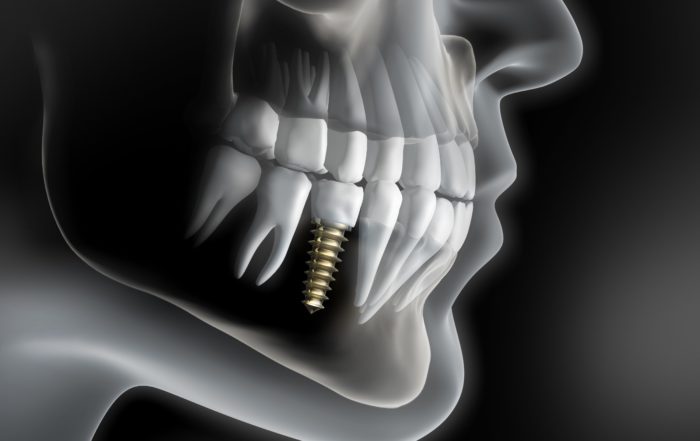 radiografía de un implante dental