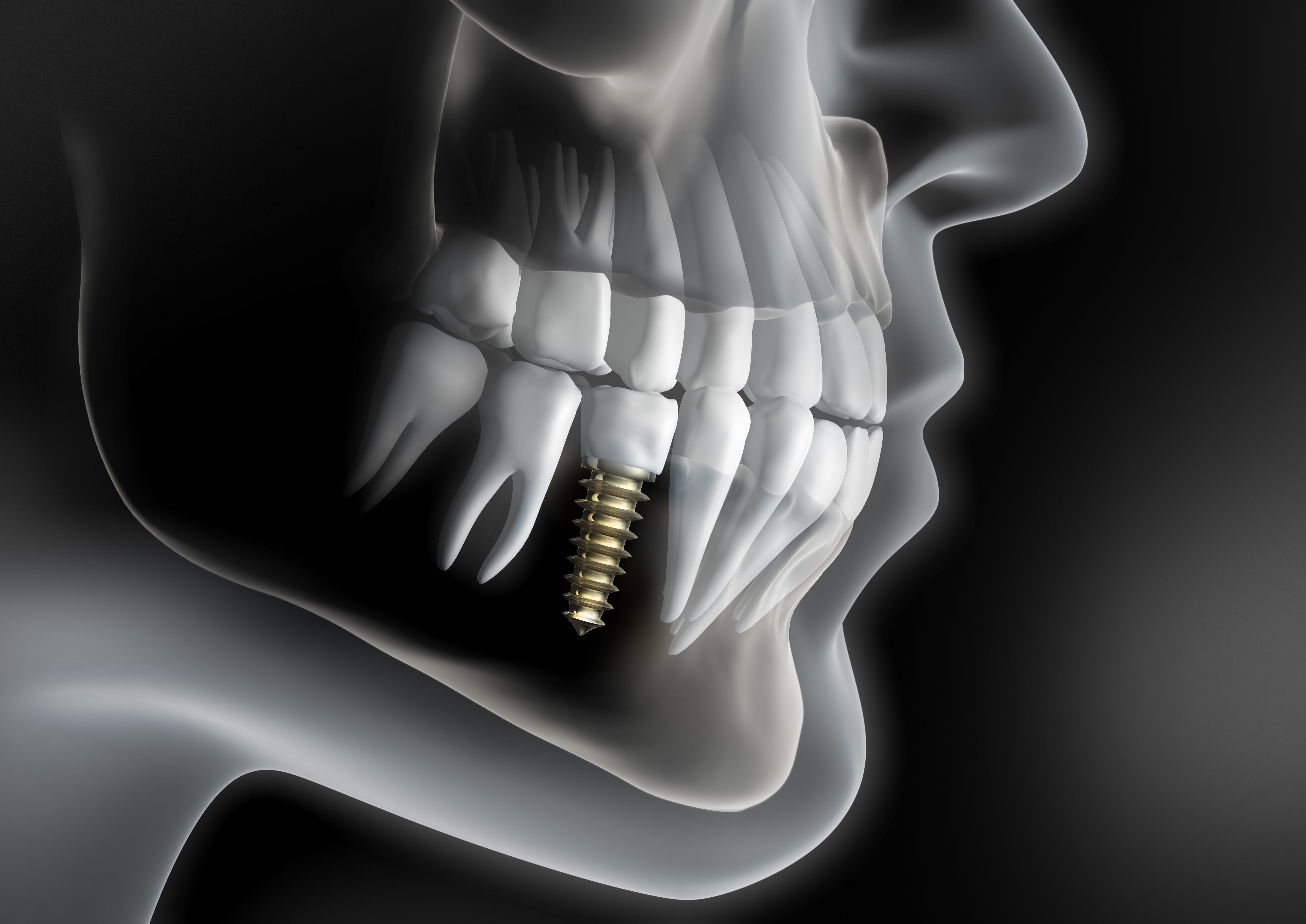 radiografía de un implante dental