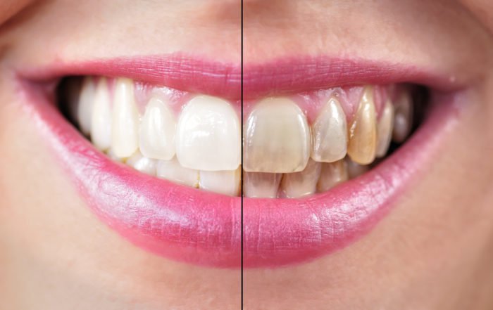 Diferencias tras blanqueamiento dental