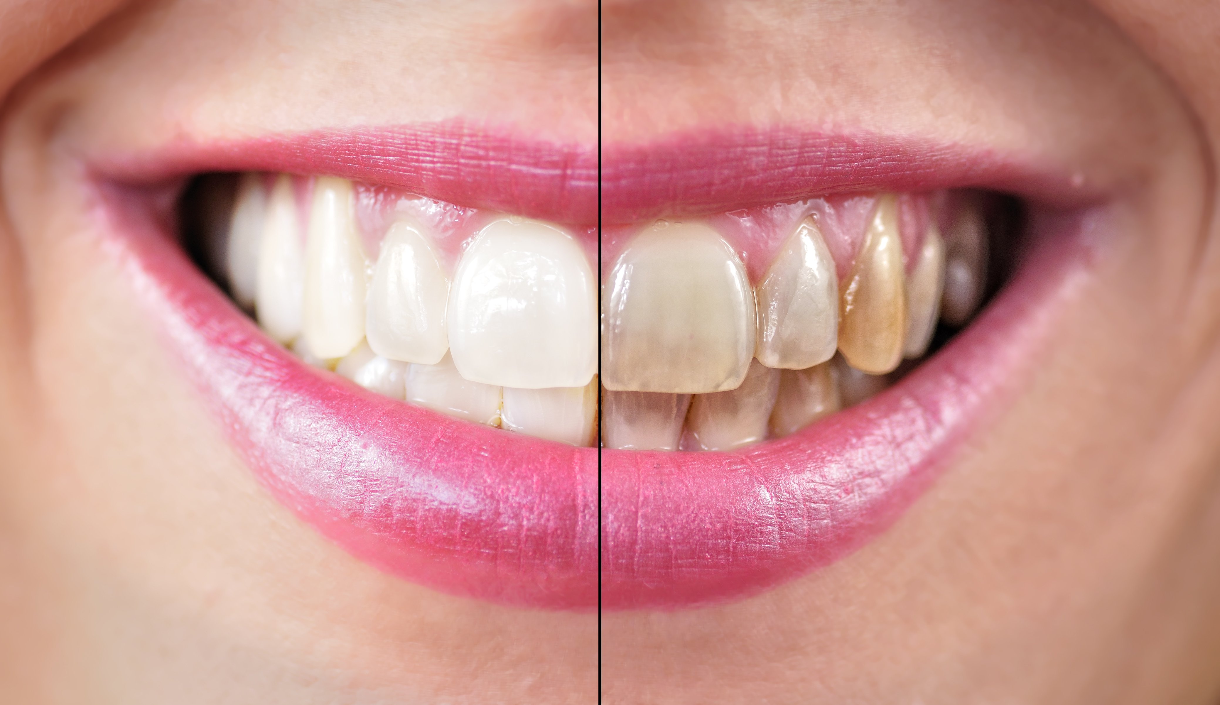 Diferencias tras blanqueamiento dental
