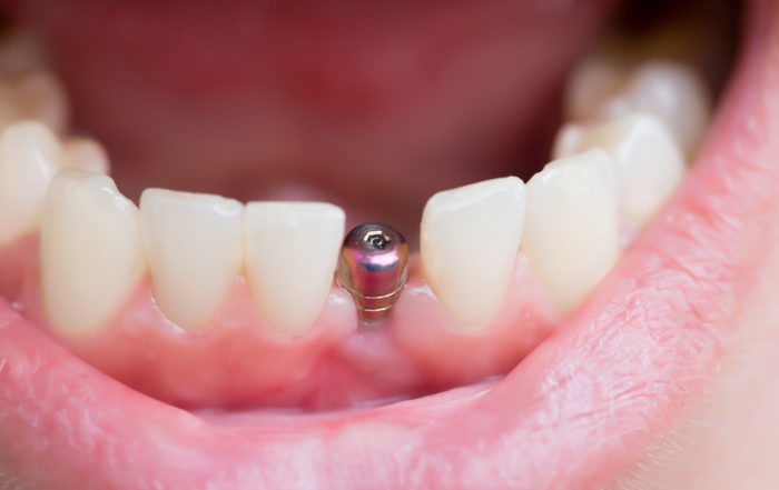fijación para implante dental