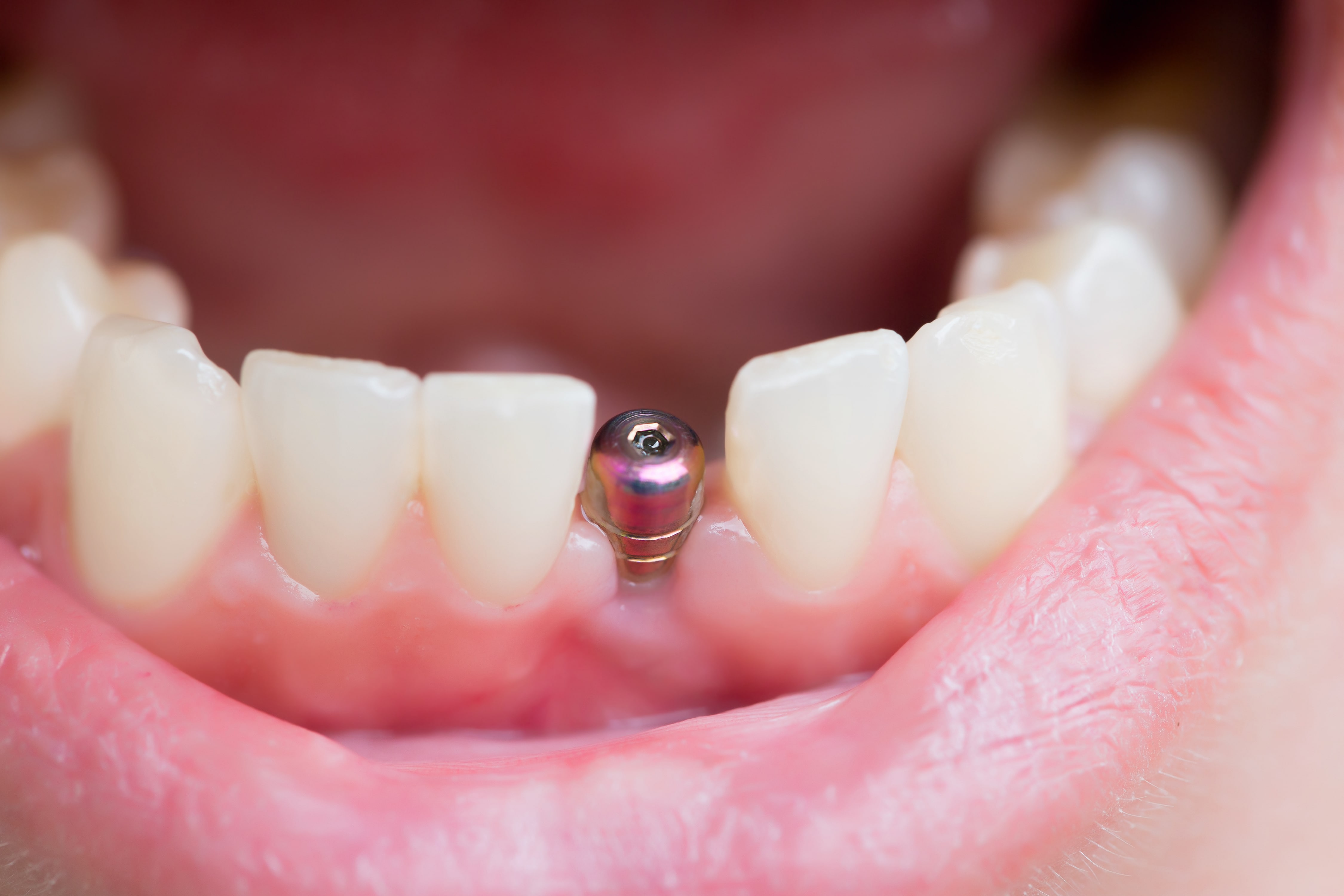 fijación para implante dental