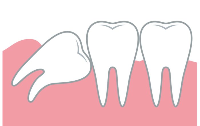 Anquilosis dental