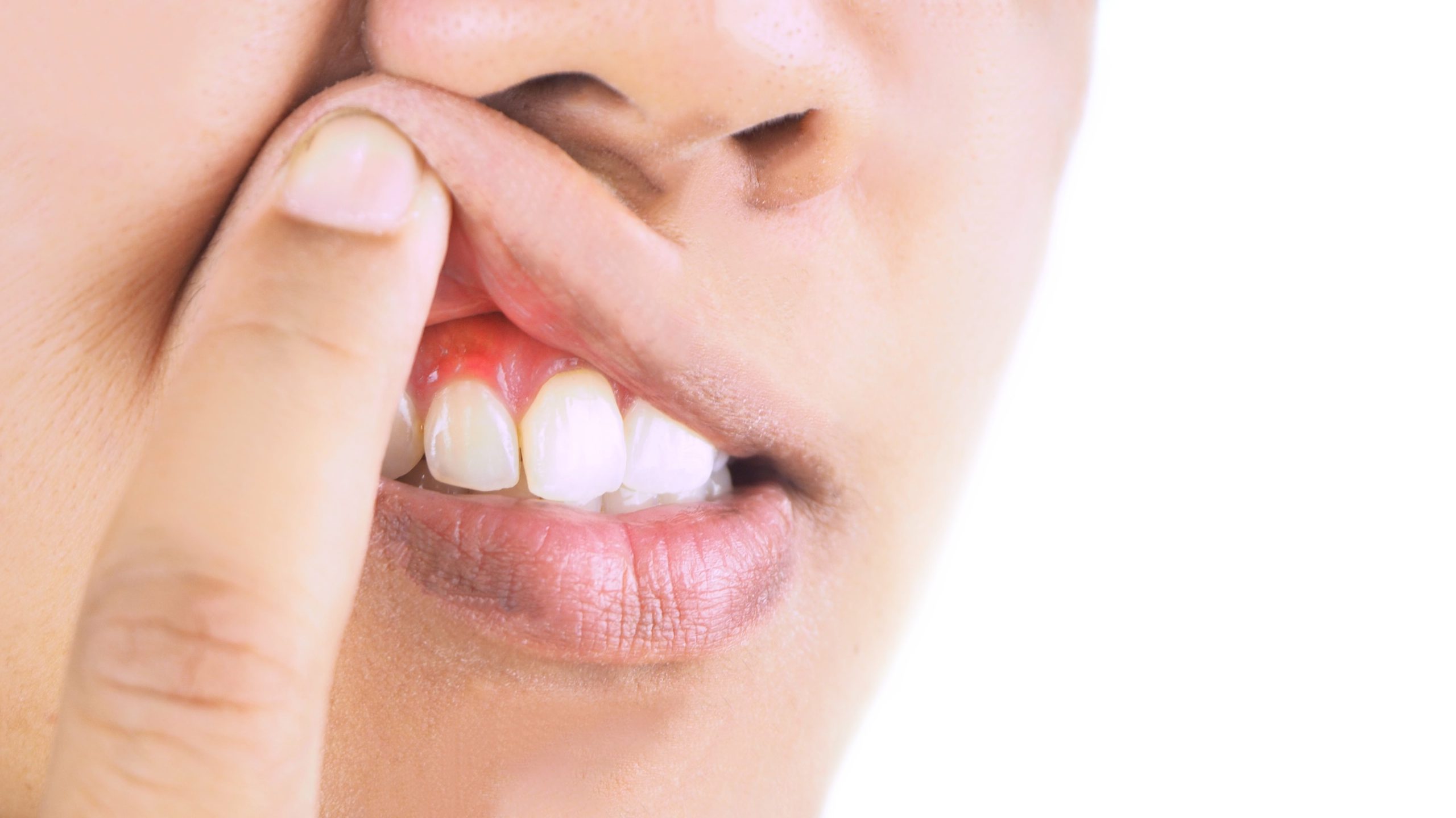 haz Incidente, evento Exclusivo Qué son las bolsas periodontales? | Clínica Dental Plata