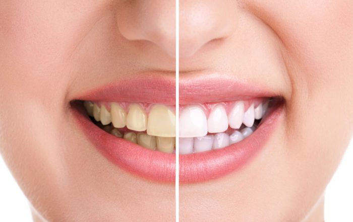Color natural de los dientes